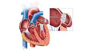 Understanding the Watchman Device: Innovative Heart Health Solution post thumbnail image