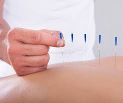 Harmonize Your Health with Acupuncture in Port Moody and Coquitlam post thumbnail image